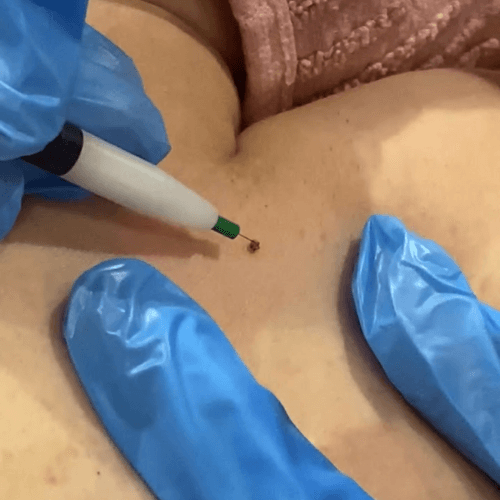 Vein Away Skin Tag Removal